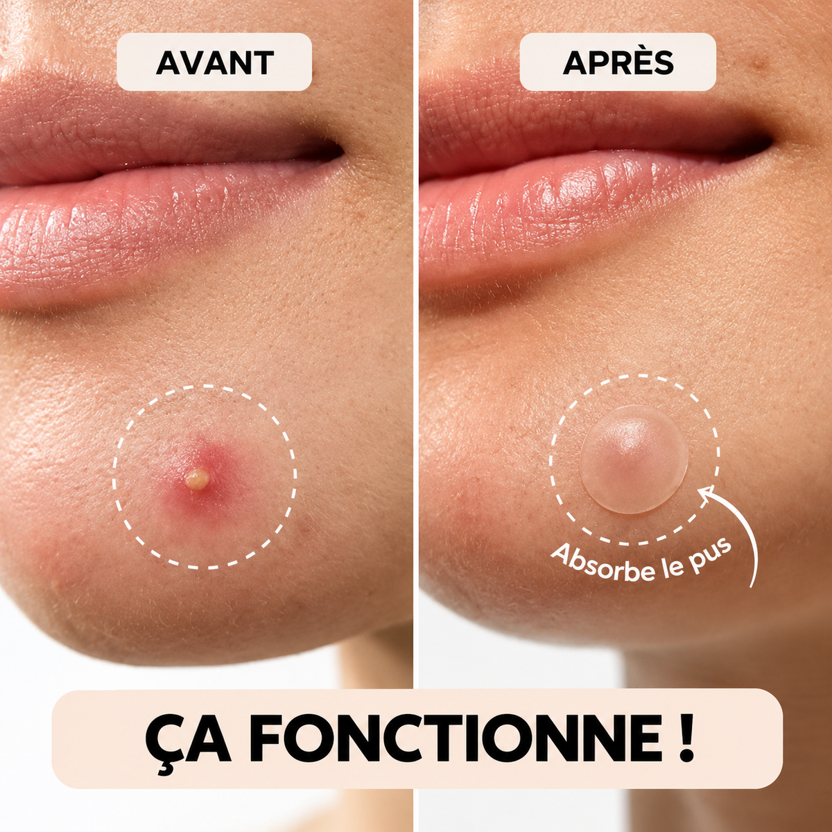 Patchs anti-imperfections invisibles – lot de 360